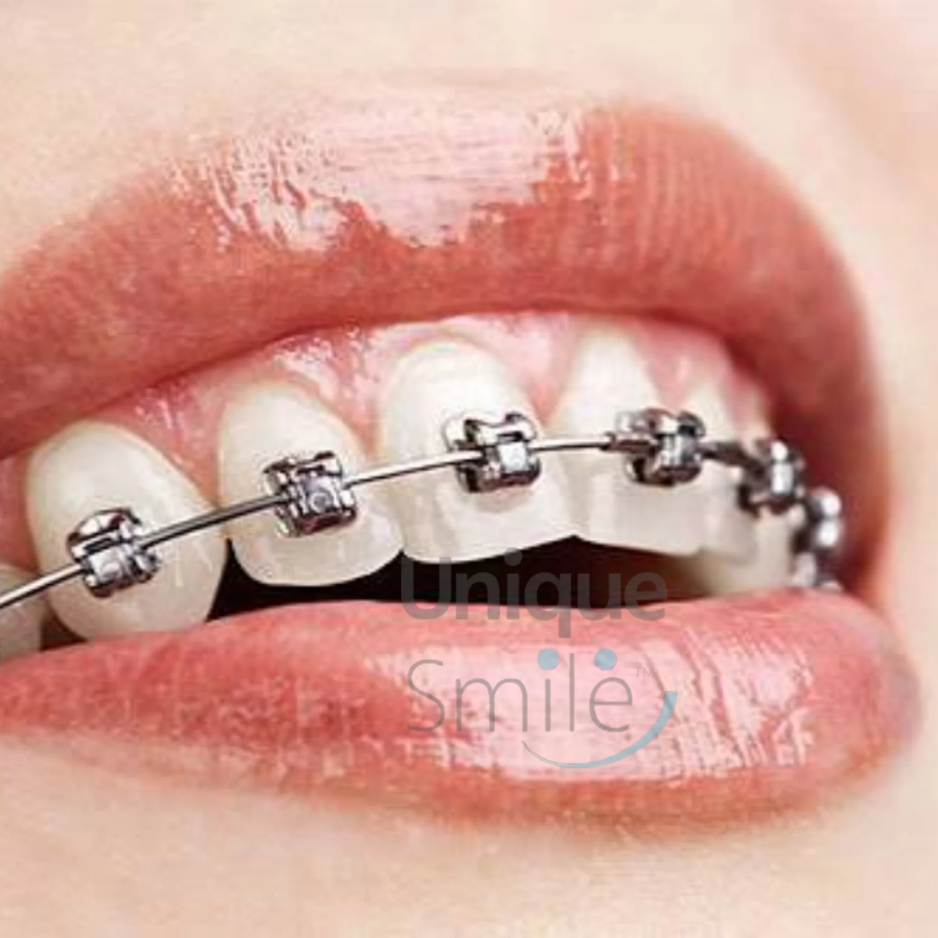 براکت ارتودنسی ثابت روی دندانها