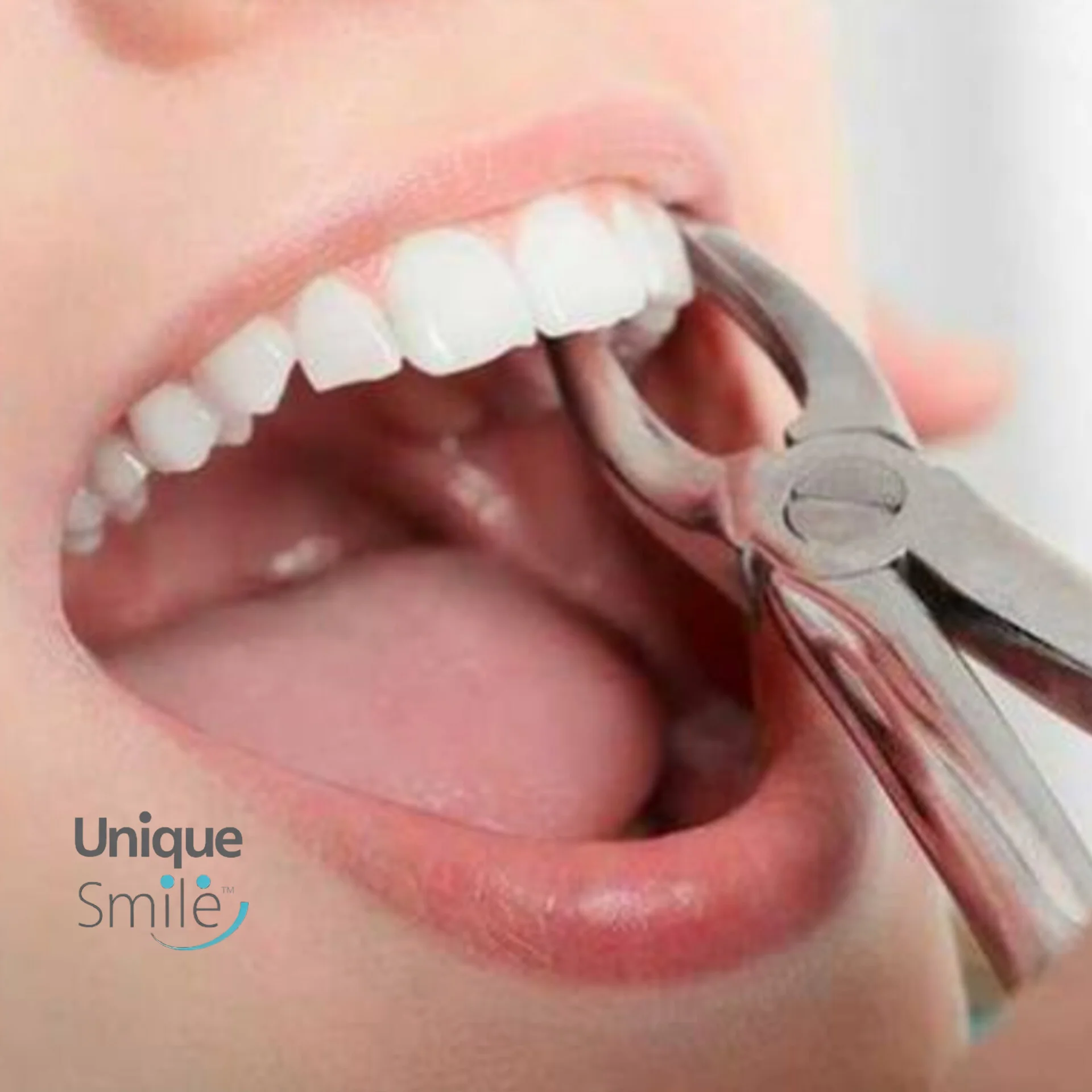 کشیدن دندان در شمال تهران (کامرانیه)