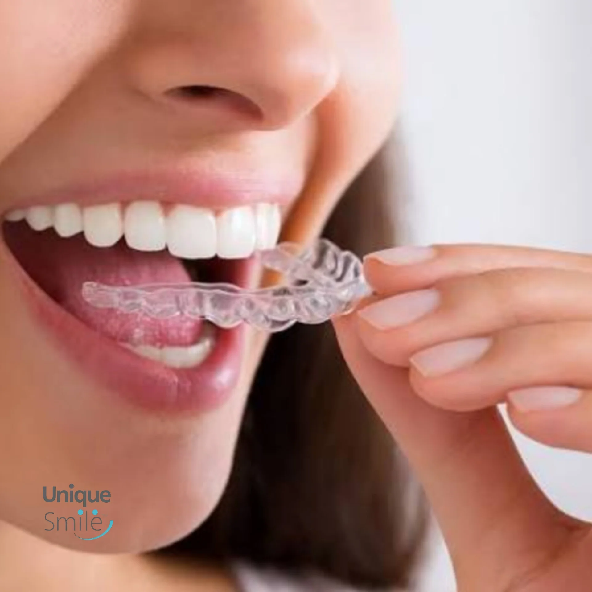 نایت گارد دو لایه در کلینیک یونیک اسمایل