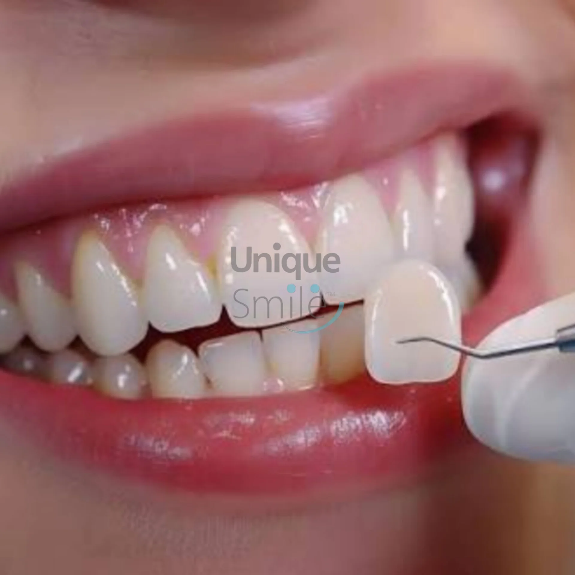 لبخند طبیعی بعد از لمینت سرامیکی