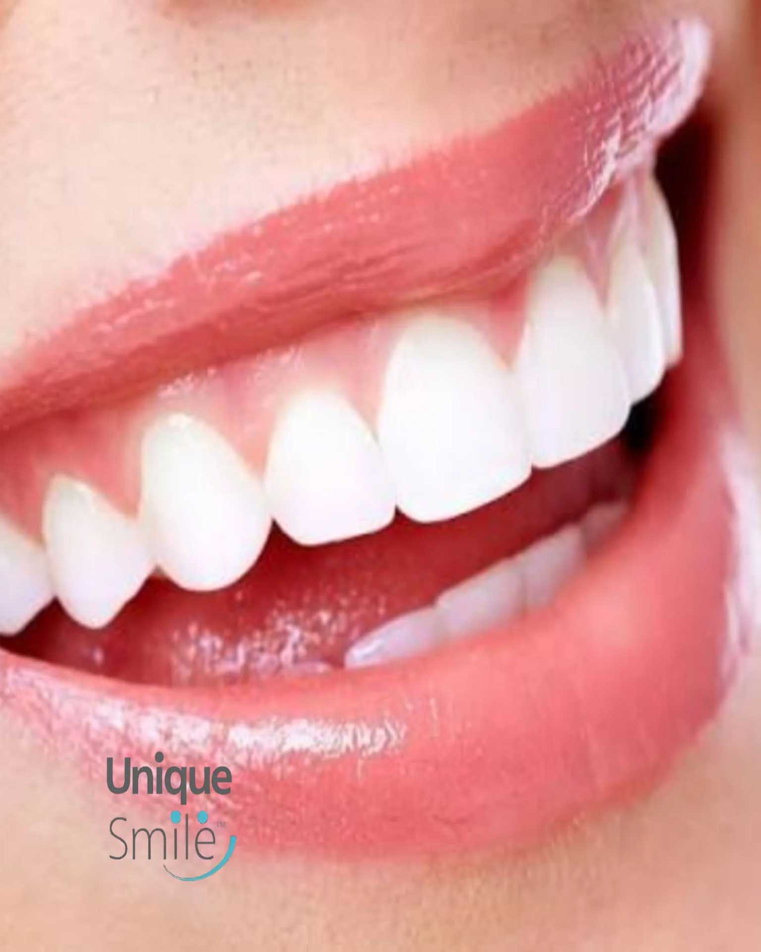 مرکز تخصصی لیفت لثه و دنتال لیفتینگ تهران