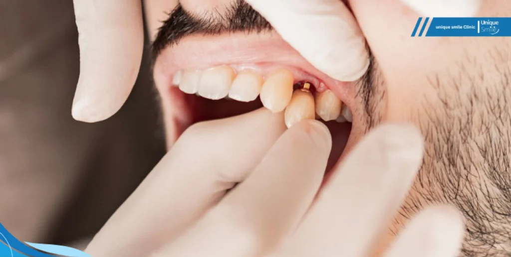 رعایت بهداشت دهان برای افزایش طول عمر ایمپلنت