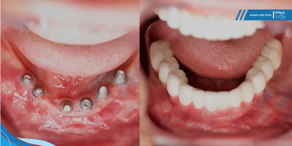 مراحل جراحی ایمپلنت پانچ و ایجاد حفره کوچک در لثه توسط دندانپزشک